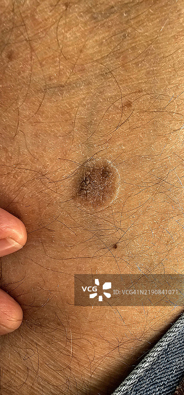 皮肤上的色素性生长图片素材