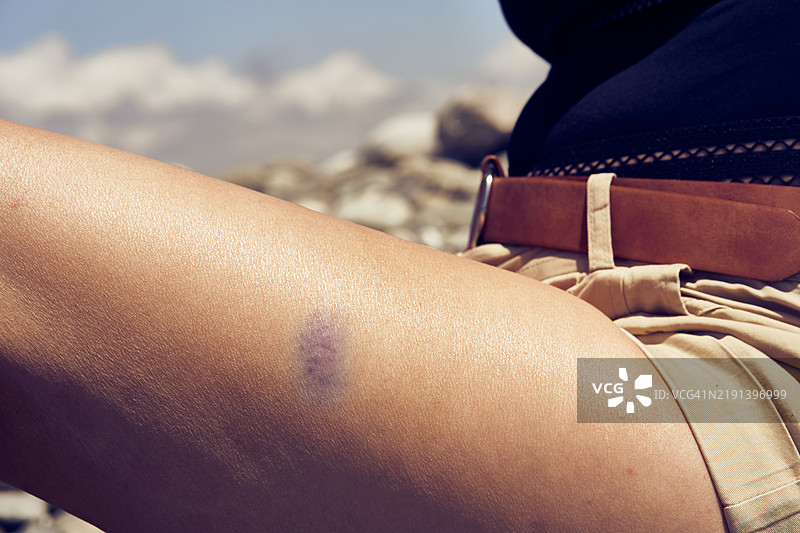 女性大腿上的淤伤特写。图片素材