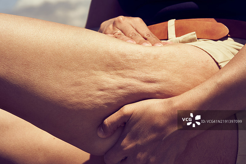 cellulite 概念。一个女人捂着她的臀部，观察她的橘皮组织。图片素材