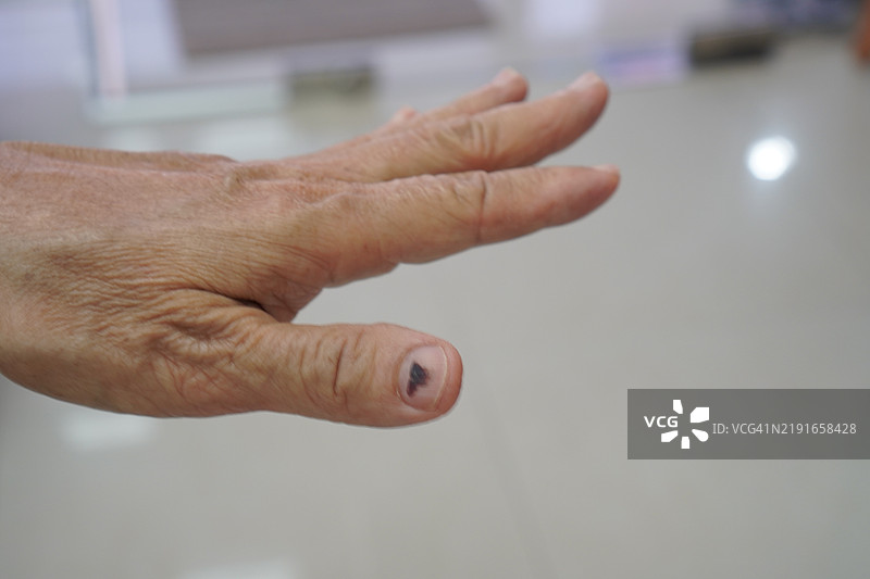 拇指下甲血肿图片素材