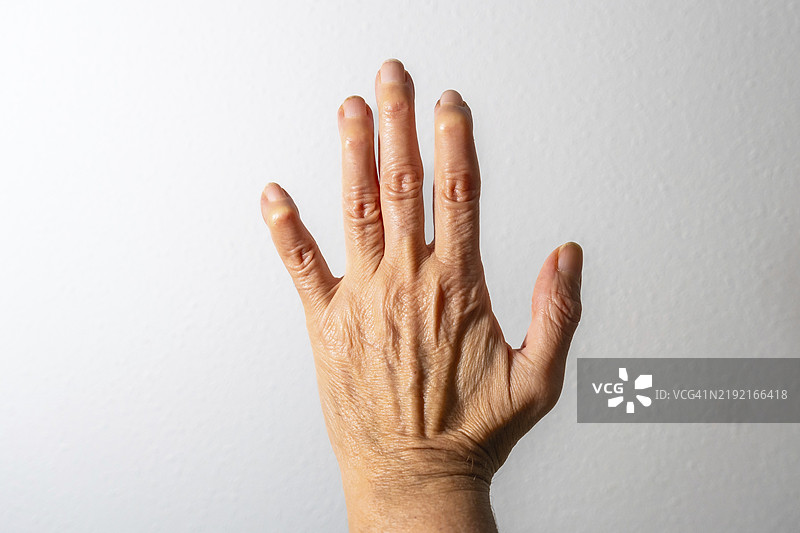 特写女性手部，展示关节炎的影响，突出关节炎症和皮肤变化。图片素材