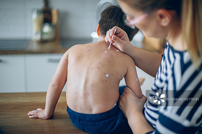 母亲给儿子涂抹药膏以对抗水痘图片素材