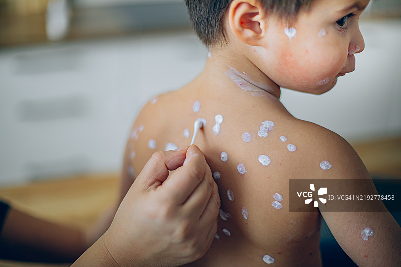 母亲在家给得水痘的小男孩涂抹消毒药水图片素材