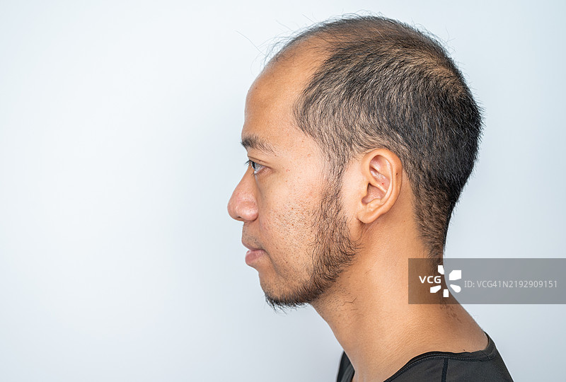 亚洲男性头皮侧面，头发稀少。秃顶与遗传和男性性激素有关。图片素材