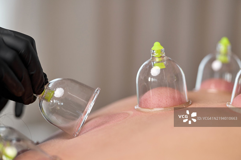 患者在腹部接受拔罐疗法以缓解疼痛图片素材