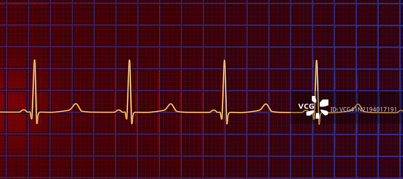 长QT综合症心电图插图图片素材