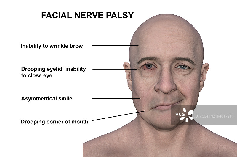 面瘫插图图片素材