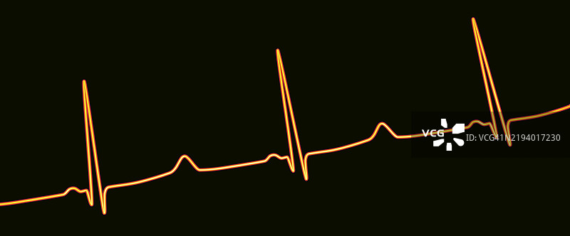 长QT综合征心电图插图图片素材