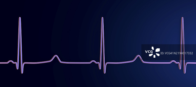 长QT综合症心电图插图图片素材