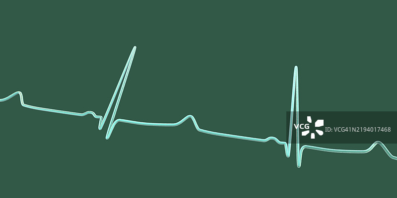 长QT综合征心电图插图图片素材