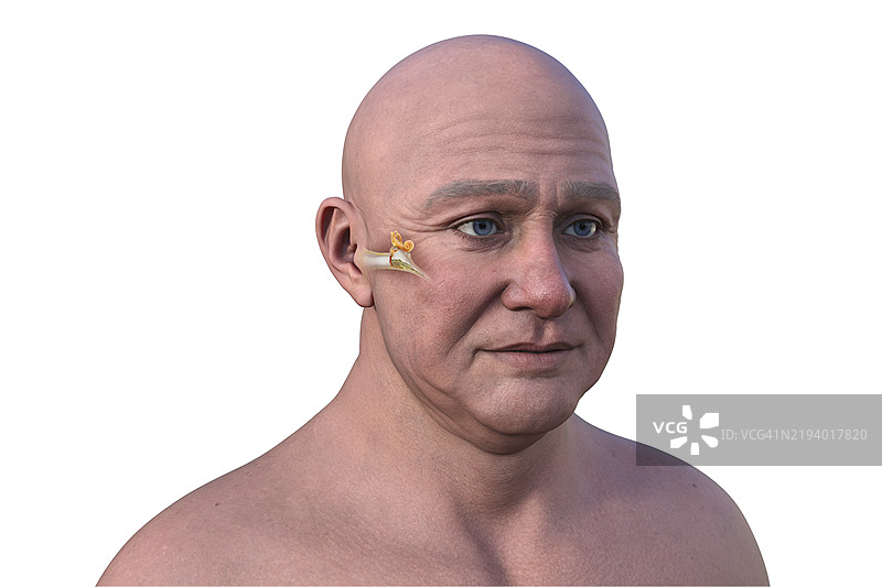 中耳炎插图图片素材