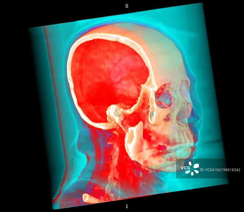 头骨，CT扫描图片素材