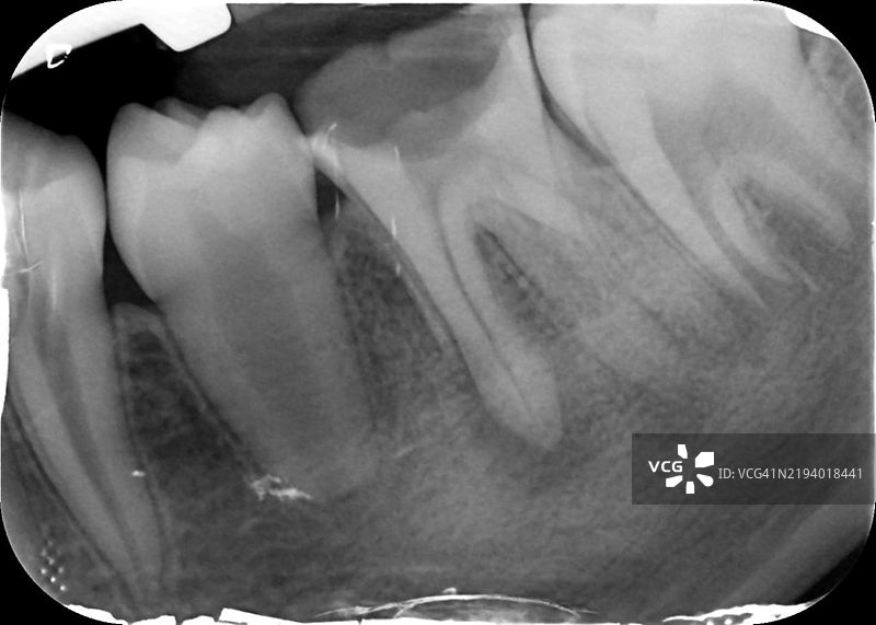 牙齿龋洞，X光检查图片素材