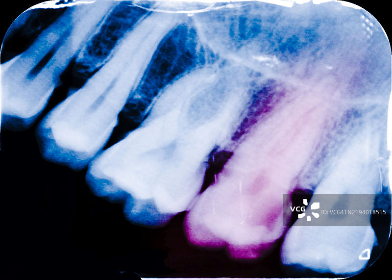 牙齿龋洞，X光检查图片素材