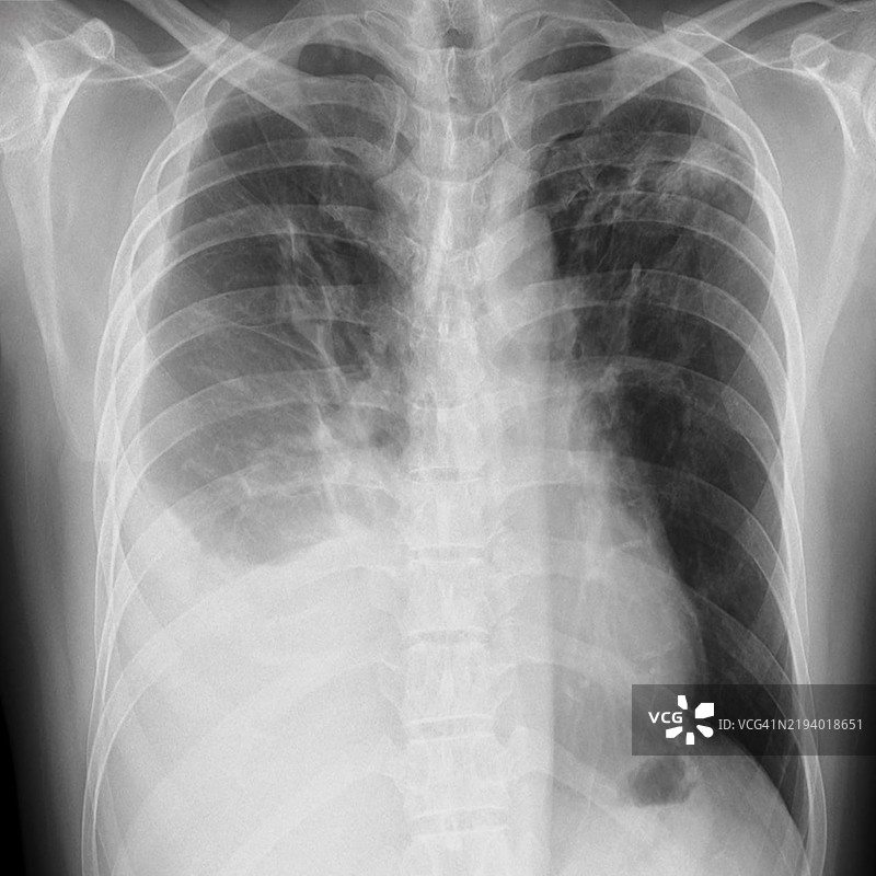 结核病，X光检查图片素材