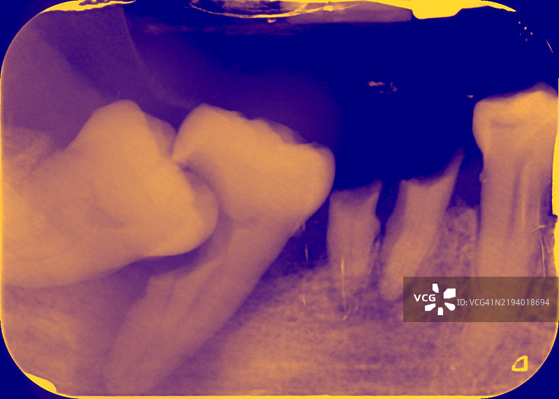 受影响的智齿，X光片图片素材