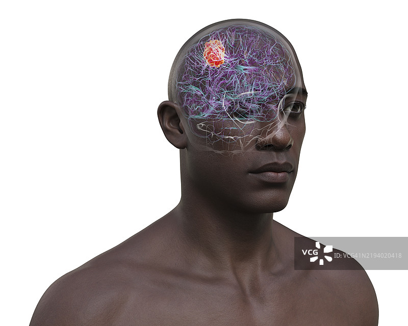 脑肿瘤插图图片素材