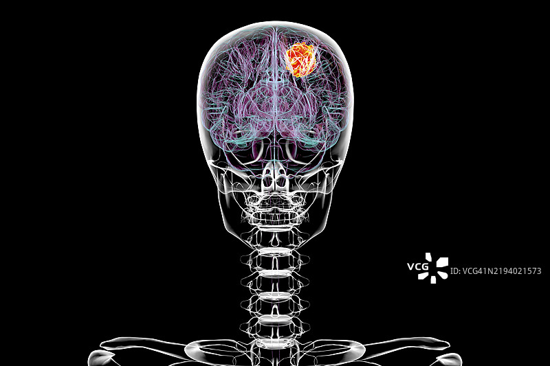 脑肿瘤插图图片素材