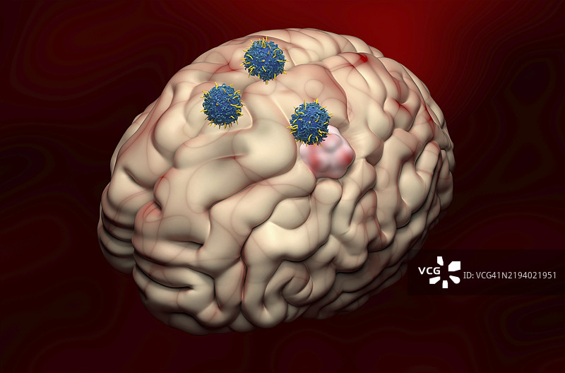 脑膜瘤的CAR-T细胞疗法插图图片素材