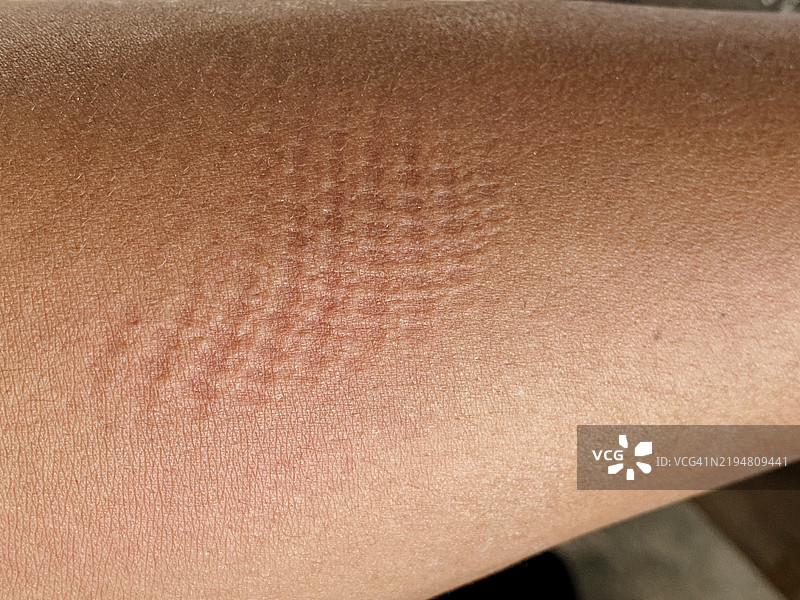 手部皮肤表面的伤口图片素材