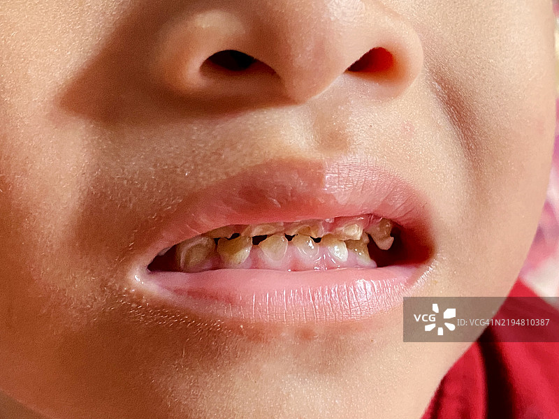儿童腐烂牙齿的特写镜头图片素材