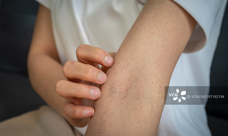 裁剪的镜头显示皮肤上出现的皮疹。皮肤皮疹可能是红色、发炎、隆起的，也可能是干燥、瘙痒或疼痛的。图片素材