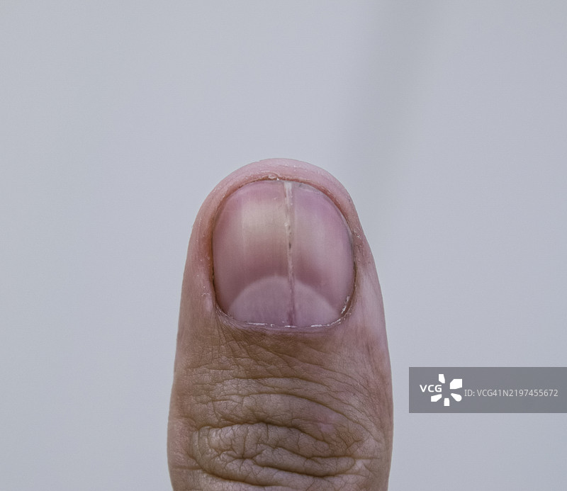 拇指上的叉状指甲，创伤性病理图片素材