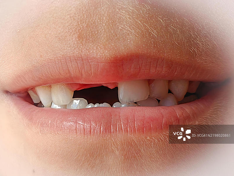 特写儿童的嘴巴，显示缺失的上门牙图片素材