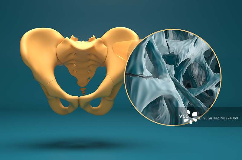 骨质疏松骨组织中的骨折插图图片素材