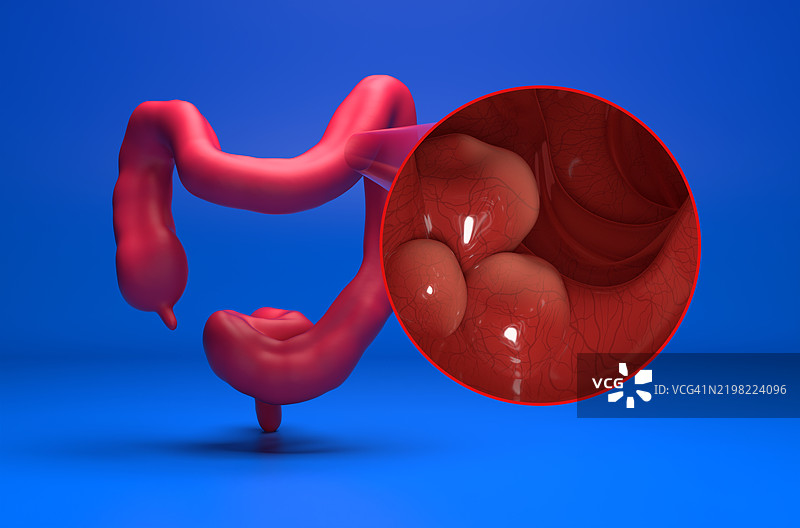 结肠癌插图图片素材