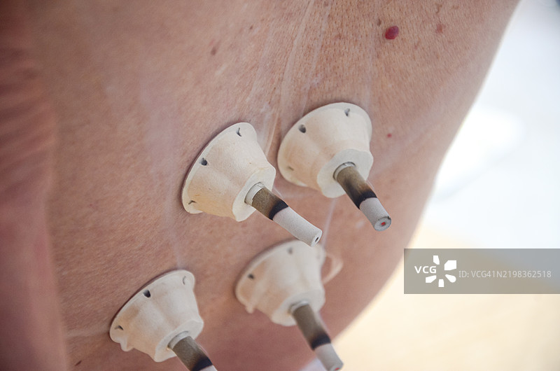 在背部接受艾灸治疗。艾灸是一种传统中医技术，通过将燃烧的艾草棒放置在人体背部的经络点上进行治疗。图片素材