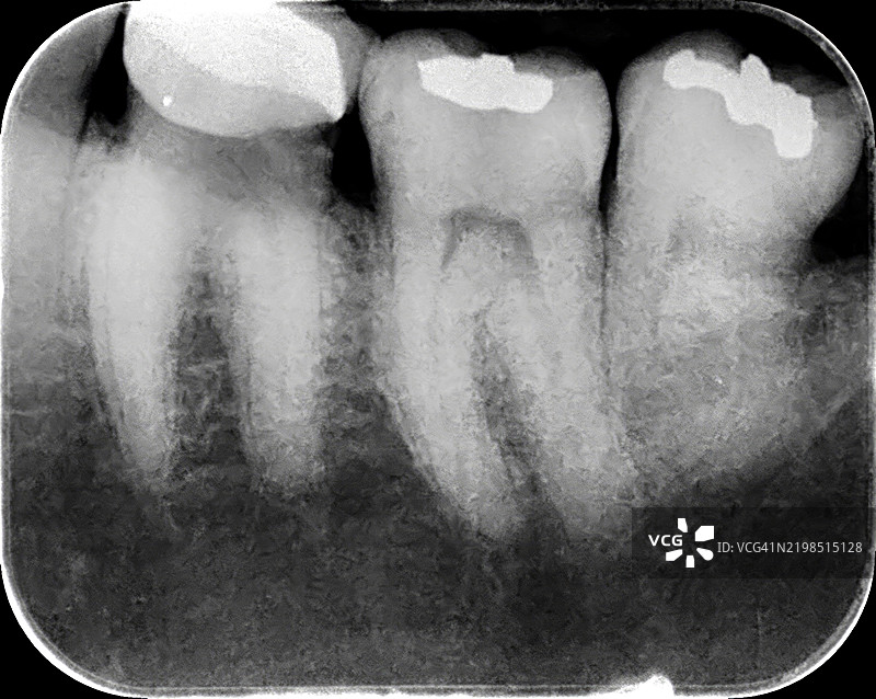 牙科X光的特写，显示有牙齿填充物和牙冠的细节。图片素材