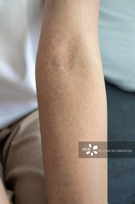 裁剪的镜头显示皮肤上出现的皮疹。皮肤皮疹可能是红色、发炎、隆起的，也可能是干燥、瘙痒或疼痛的。图片素材