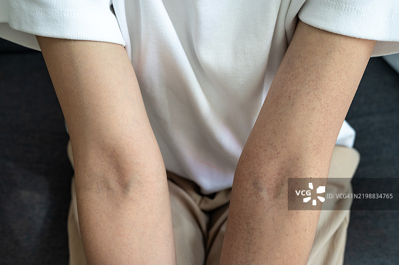 裁剪的镜头显示皮肤上出现的皮疹。皮肤皮疹可能是红色、发炎、隆起的，也可能是干燥、瘙痒或疼痛的。图片素材