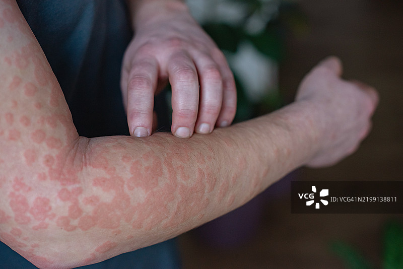 特写镜头，红色的瘙痒皮疹，手指疯狂抓挠发炎的皮肤图片素材
