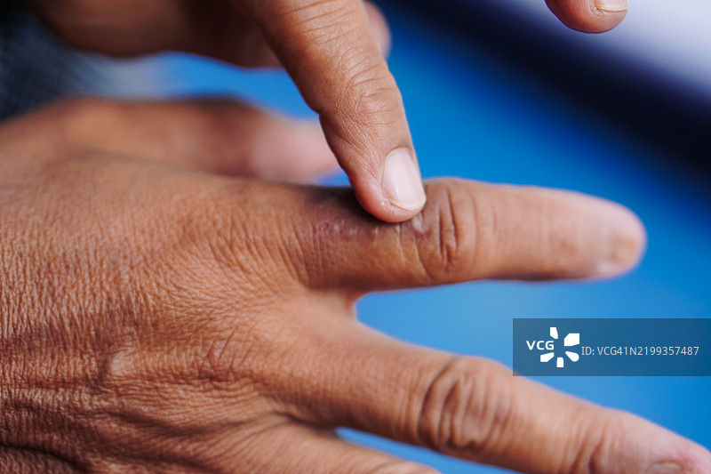 真菌指甲感染图片素材