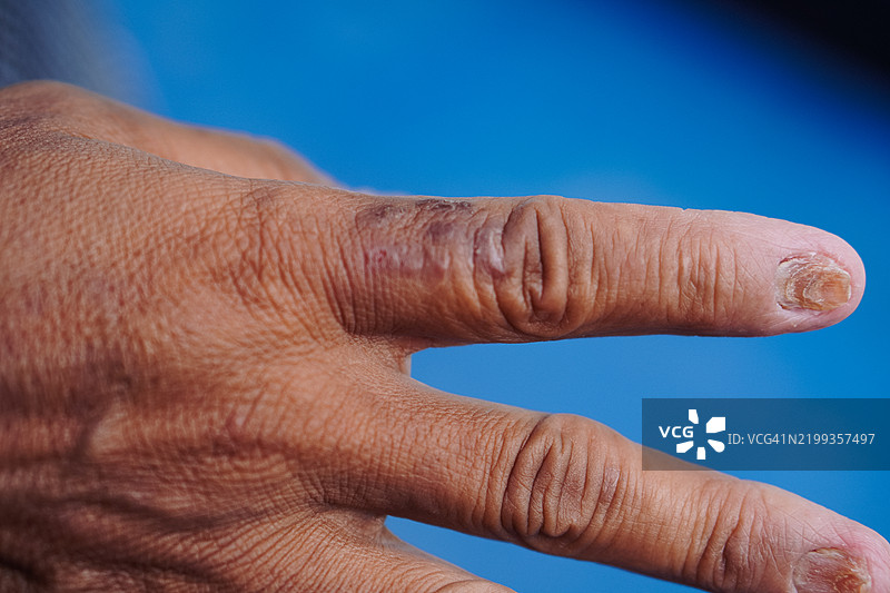 真菌指甲感染图片素材