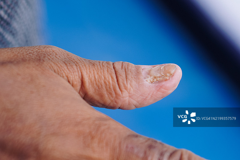 真菌指甲感染图片素材