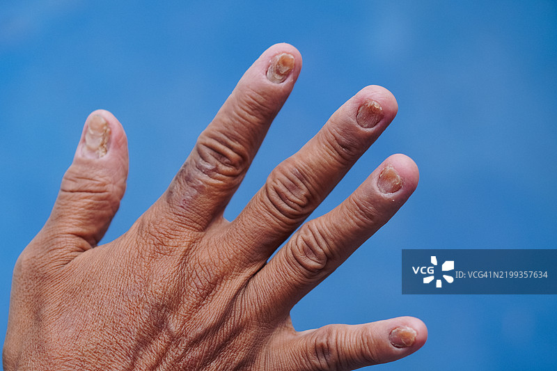 手部正在恢复的真菌指甲感染图片素材