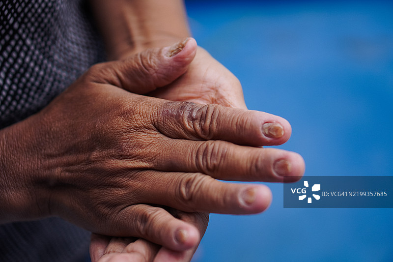 手部正在恢复的真菌指甲感染图片素材