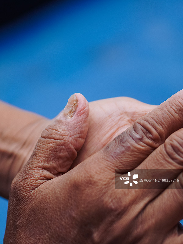手部正在恢复的真菌指甲感染图片素材