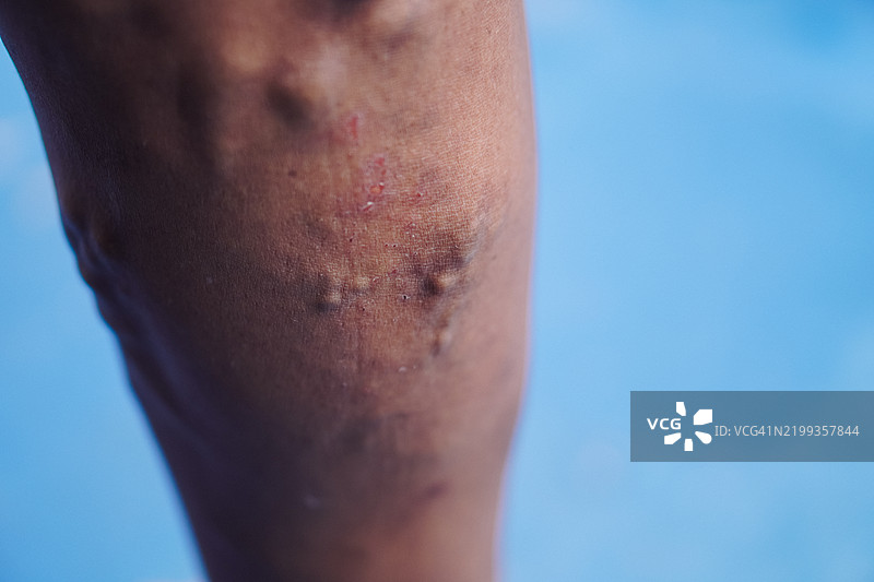 人腿特写，皮肤发炎和静脉曲张图片素材
