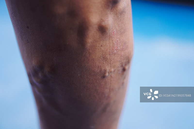 人腿特写，皮肤发炎和静脉曲张图片素材