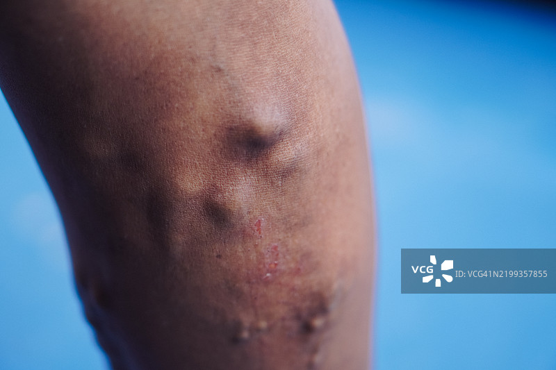 人腿特写，皮肤发炎和静脉曲张图片素材