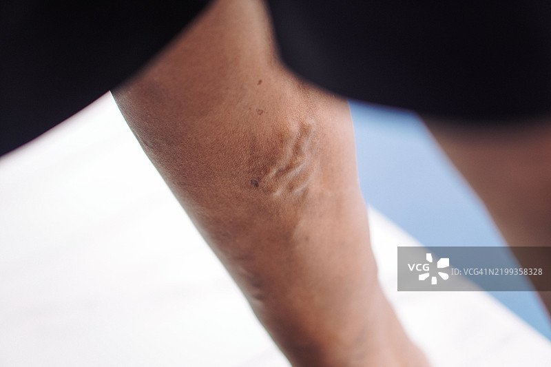 人腿特写，皮肤发炎和静脉曲张图片素材