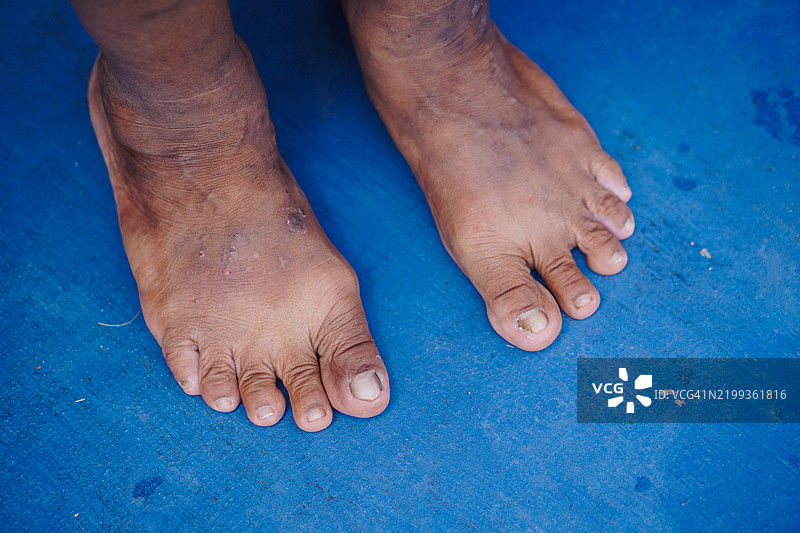 真菌指甲感染图片素材