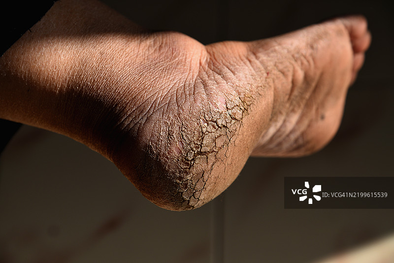 干裂的脚跟，冬季干燥皮肤问题图片素材