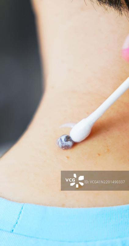 痣的治疗和伤口护理图片素材