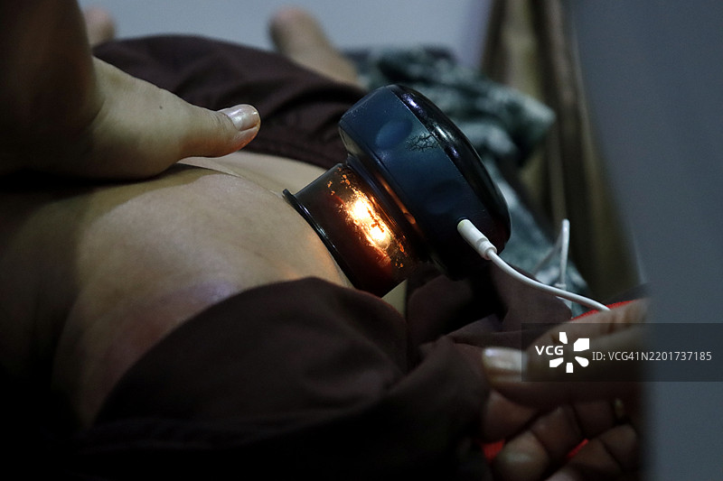 一位针灸师在患者的背部使用古老的拔罐技术。图片素材