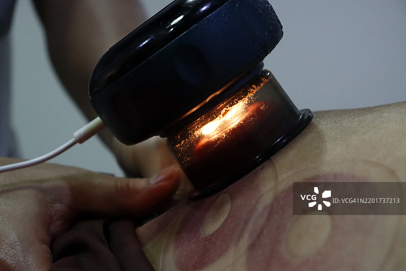 治疗师的手正在进行拔罐治疗图片素材